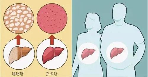 脂肪肝、酒精肝......為什么肝病開始“招惹”年輕人？