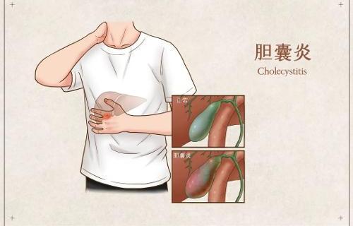元宵節(jié)到了，膽囊炎患者適合吃湯圓嗎？