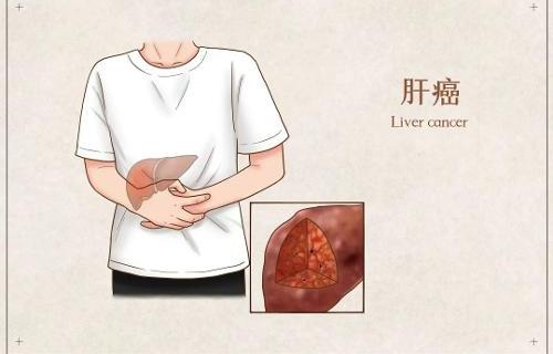 為什么肝功能正常，卻還是得了肝癌？聽專家怎么說