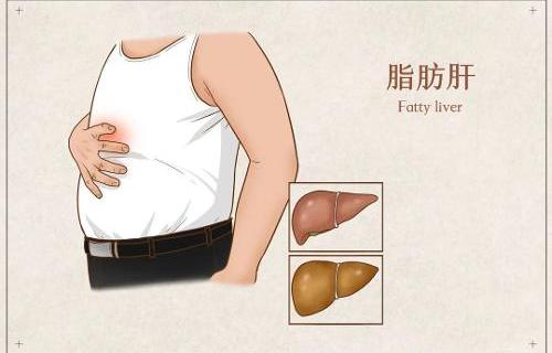 節(jié)后酒精肝、脂肪肝找上門怎么辦？