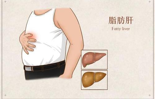 年輕人怎樣預(yù)防脂肪肝